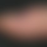 Onychodystrophia psoriatica. proximal strongly dented nail plate of the right thumb in a 26-year-...