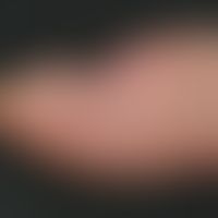 Onychodystrophia psoriatica. proximal strongly dented nail plate of the right thumb in a 26-year-...