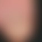 Onychodystrophia psoriatica. moderate onychodystrophy of the index finger nail of a 30-year-old m...