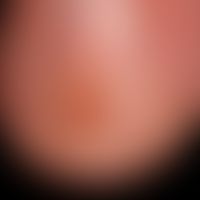 Onychodystrophie.&nbsp;Traumatische Onychodystrophie mit Splitterblutungen.
