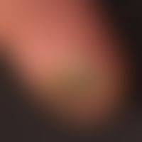 Onychodystrophie durch Onychomykose (Schimmelpilzinfektion der Nägel)
