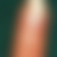 Onycholysis semilunaris. Bogenförmige, traumatogen bedingte Ablösung des Nagels. Einsaugen von Fl...