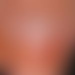 Onycholyse, medikamentöse bzw. lichtinduzierte. Detailvergrößerung: Seit 3 Wochen persistierende,...