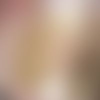 Onycholyse, medikamentöse bzw. lichtinduzierte. Auflichtmikroskopie: Gelblich-bräunliche Verfärbu...