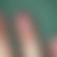 Onychophagie:&nbsp;Fehlen der distalen Nagelplatte am Zeigefinger durch Abbeißen bei einer 33-jäh...