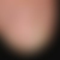 Onychorrhexis:&nbsp;seit 2 Jahren persistierendes, längsfaseriges Aufsplittern des Nagels von Dig...