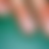 Onychorrhexis:&nbsp;längsfaserige Aufsplitterung der Fingernägel bei gleichzeitiger Atrophie der ...