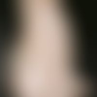 Arthritis, psoriatic. pronounced malposition of the fingers with misshapen, painful swelling of t...