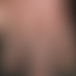 Psoriasisarthritis:&nbsp;&nbsp;solitäre oder multiple, chronisch dynamische, rezidivierende, salt...