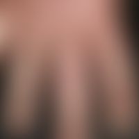 Arthritis, psoriatic. solitary or multiple, chronically dynamic, recurrent, salty arthritis, espe...