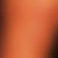 Follikulitis superfizielle&nbsp;(Ostiofollikulitis):&nbsp;multiple follikuläre Pusteln. Nachweis ...