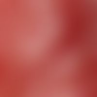 Follikulitis superfizielle&nbsp;(Ostiofollikulitis):Auflichtmikroskopie: Halsbereich einer 46-jäh...