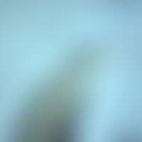 Oxyuriasis. Schwanz eines Enterobius vermicularis-Weibchens. Typisch ist das extrem zugespitzte H...