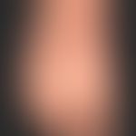 Pachyonychia congenita: alle Finger- und Zehennägel betreffende, angeborene Nageldystrophie mit P...