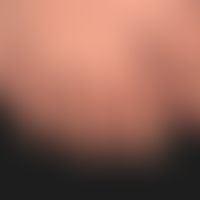 Pachyonychia congenita: alle Finger- und Zehennägel betreffende, angeborene Nageldystrophie mit P...