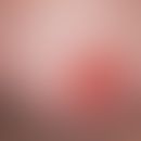 Paget, M. der Brustwarze. Seit mehreren Monaten bestehendes Infiltrat der Brustwarze, einseitig, ...
