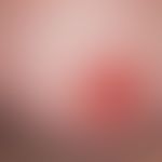 Paget, M. der Brustwarze. Seit mehreren Monaten bestehendes Infiltrat der Brustwarze, einseitig, ...
