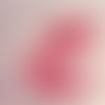 Paget, M. der Brustwarze. Seit mehreren Monaten bestehende, einseitige, symptomlose, therapieresi...