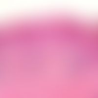 Paget, M. der Brustwarze. Übersichtsaufnahme: Intraepithelial lokalisierte, solitäre oder in Grup...