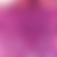 Paget, M. der Brustwarze. Detailvergrößerung: Intraepithelial lokalisierte, solitäre oder in Grup...