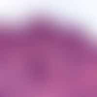 Paget, M., extramammärer. Hyperplastisches Oberflächen- und Tiefenepithel mit regellos zerstreute...