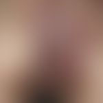 Paget, M., extramammärer. Übersichtsaufnahme: Seit Jahren persistierendes, scharf begrenztes, gro...