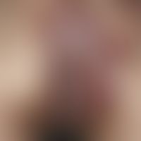 Paget, M., extramammärer. Übersichtsaufnahme: Seit Jahren persistierendes, scharf begrenztes, gro...