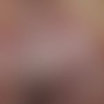 Paget, M., extramammärer. Detailvergrößerung: Scharf begrenztes, großflächiges, erodiertes, mazer...