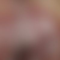 Paget, M., extramammärer. Detailvergrößerung: Scharf begrenztes, großflächiges, erodiertes, mazer...