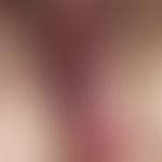 Paget, M., extramammärer. Solitäre, chronisch dynamische, seit 3 Jahren kontinuierlich wachsende,...