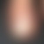 Panaritium, which developed in an HIV-infected patient approximately 3 months after a previously ...