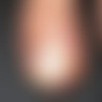 Panaritium:&nbsp;Panaritium, das sich bei einem HIV-Infizierten Patienten ca. 3 Monate nach einer...