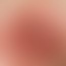 Papilloma: Single, chronically dynamic, since 3 months existing, slowly increasing, 0.3 cm large,...