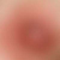 Papilloma: Single, chronically dynamic, since 3 months existing, slowly increasing, 0.3 cm large,...