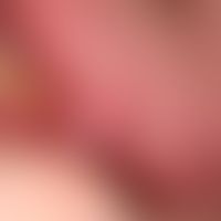 Papilloma of the oral mucosa: 0.7 x 0.3 cm measuring, fissured, coarse, not pressure-painful, pin...