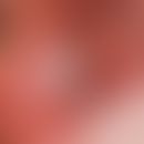 Papillomatosis, florid oral leukoplakia of the buccal mucosa, existing for several months, partly...