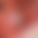 Papillomatosis, florid oral leukoplakia of the buccal mucosa, existing for several months, partly...