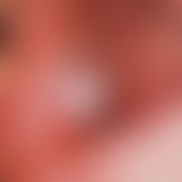 Papillomatosis, florid oral leukoplakia of the buccal mucosa, existing for several months, partly...