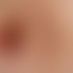 Papillomatosis confluens et reticularis. years ago, initially dark discolouration in the neck are...
