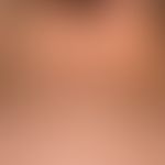Papillomatosis confluens et reticularis. confluent, brownish hyperpigmented papules in the neck r...