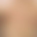 papillomatosis confluens et reticularis. since 2 years increasing discoloration and thickening of...