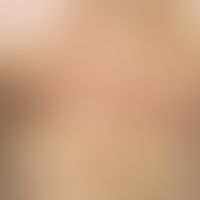 papillomatosis confluens et reticularis. since 2 years increasing discoloration and thickening of...