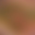 Papillomatosis cutis carcinoides. Blumenkohlartige, schmutziggraubraune Vegetationen, leicht blut...