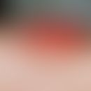 Papillomatosis cutis carcinoides, bright red, bare, exophytic, cauliflower-like vegetation on una...