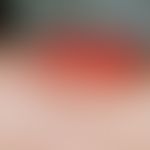 Papillomatosis cutis carcinoides. Hellrote, nackte, exophytische, blumenkohlartige Vegetationen a...