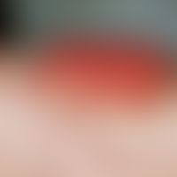 Papillomatosis cutis carcinoides. Hellrote, nackte, exophytische, blumenkohlartige Vegetationen a...