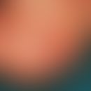 Papillomatosis cutis lymphostatica. Papillomatöse Hautveränderungen im Bereich eines mittels Ansa...