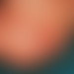 Papillomatosis cutis lymphostatica. Papillomatöse Hautveränderungen im Bereich eines mittels Ansa...