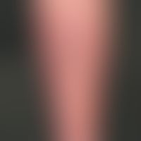 Papillomatosis cutis lymphostatica. Übersichtsaufnahme: Nach distal scharf, nach proximal unschar...