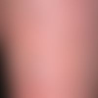 Papillomatosis cutis lymphostatica. detail enlargement: brownish-red papules and plaques. in the ...